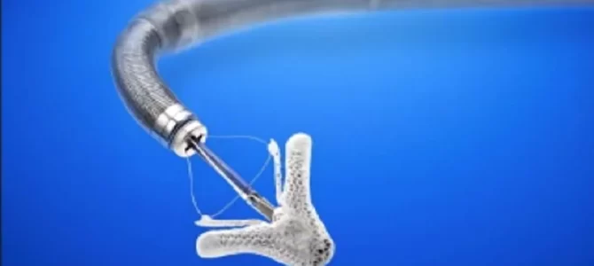 Como o MitraClip Funciona? Saiba tudo sobre!